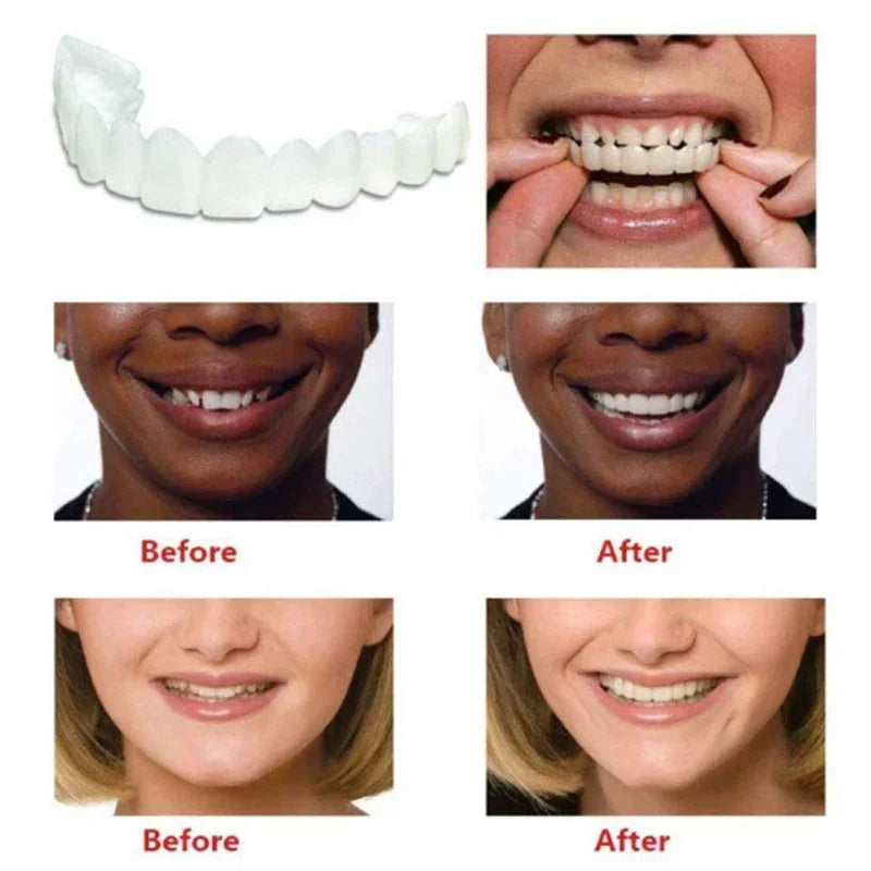 Snap On Smile Braces Premium Quality