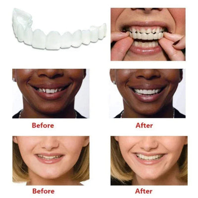 Snap On Smile Braces Premium Quality
