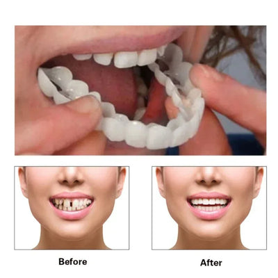Snap On Smile Braces Premium Quality